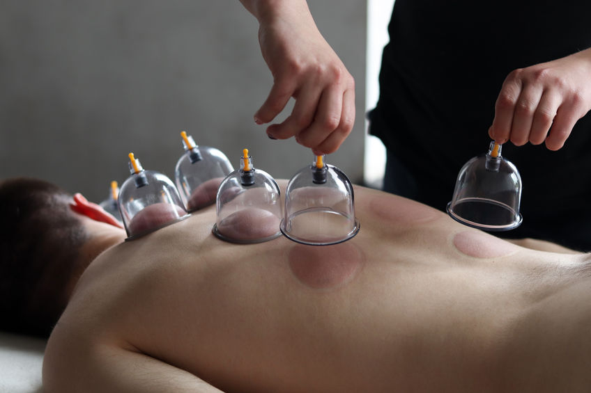 Cupping Therapy in Los Angeles, CA